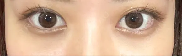 クマ治療 / 下まぶたたるみ取り / 下まぶたの脂肪取り APOLLO BEAUTY CLINIC AFTER メイン用