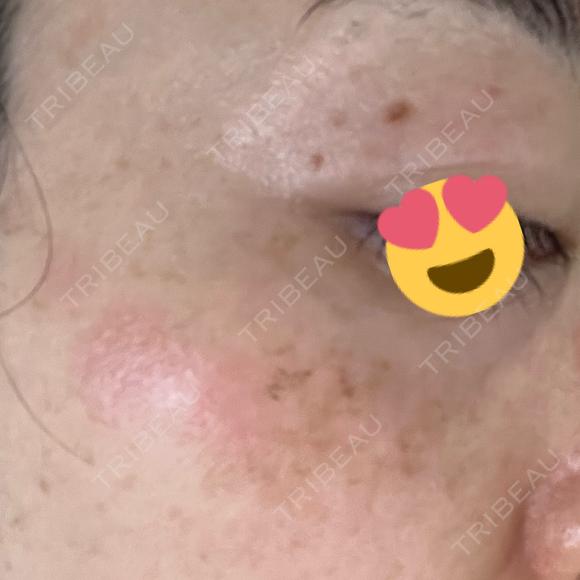 シミ取りレーザー Jスキンクリニック 【J-SKIN clinic】 DAY 10 メイン用