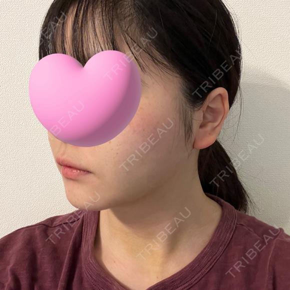 糸リフト / 脂肪吸引（顔） / ジョールファット除去 東京シンデレラ美容外科 池袋院 DAY 11 メイン用