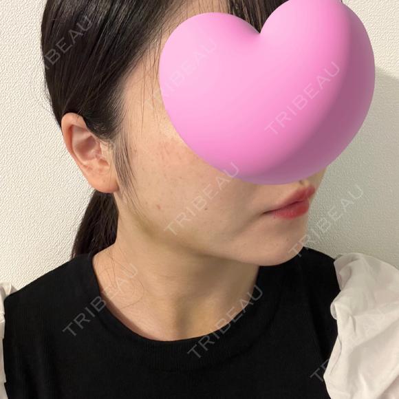 糸リフト / 脂肪吸引（顔） / ジョールファット除去 東京シンデレラ美容外科 池袋院 DAY 12 メイン用