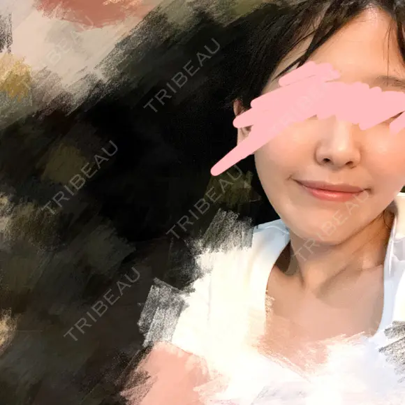 骨切り（あご） / 脂肪吸引（顔） 銀座マイアミ美容外科 DAY 90 メイン用