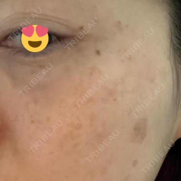 シミ取りレーザー Jスキンクリニック 【J-SKIN clinic】 DAY 13 メイン用