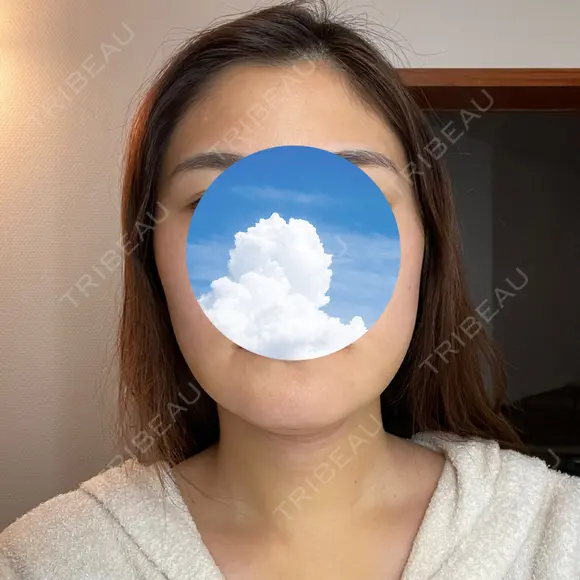 糸リフト / 骨切り（あご） / 骨削り（エラ） / 脂肪吸引（顔） 銀座マイアミ美容外科 DAY 7 メイン用