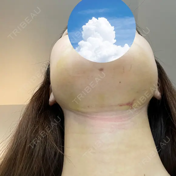 糸リフト / 骨切り（あご） / 骨削り（エラ） / 脂肪吸引（顔） 銀座マイアミ美容外科 DAY 7 メイン用