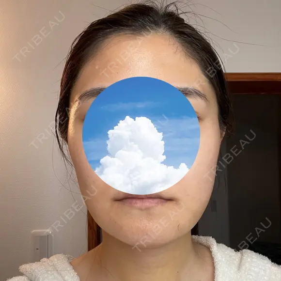 糸リフト / 骨切り（あご） / 骨削り（エラ） / 脂肪吸引（顔） 銀座マイアミ美容外科 DAY 8 メイン用