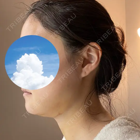 糸リフト / 骨切り（あご） / 骨削り（エラ） / 脂肪吸引（顔） 銀座マイアミ美容外科 DAY 8 メイン用