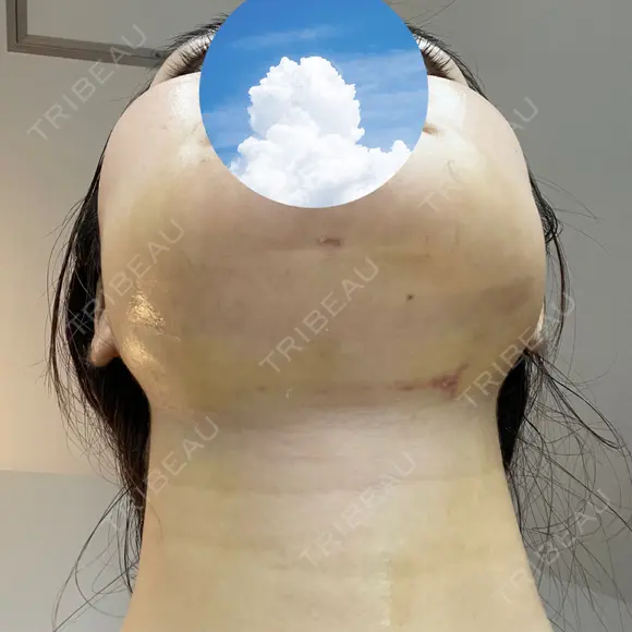 糸リフト / 骨切り（あご） / 骨削り（エラ） / 脂肪吸引（顔） 銀座マイアミ美容外科 DAY 8 メイン用