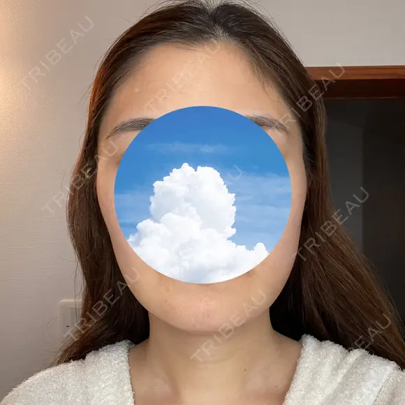 糸リフト / 骨切り（あご） / 骨削り（エラ） / 脂肪吸引（顔） 銀座マイアミ美容外科 AFTER メイン用