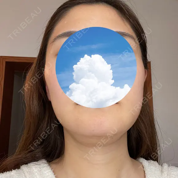 糸リフト / 骨切り（あご） / 骨削り（エラ） / 脂肪吸引（顔） 銀座マイアミ美容外科 DAY 10 メイン用