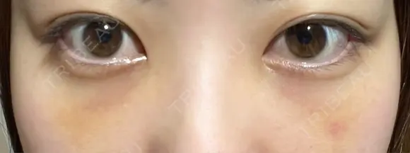 クマ治療 / 下まぶたたるみ取り / 下まぶたの脂肪取り APOLLO BEAUTY CLINIC DAY 6 メイン用