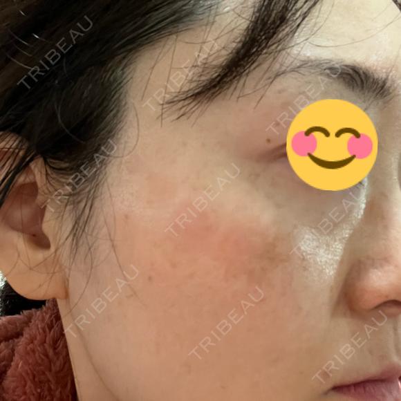 シミ取りレーザー Jスキンクリニック 【J-SKIN clinic】 DAY 15 メイン用