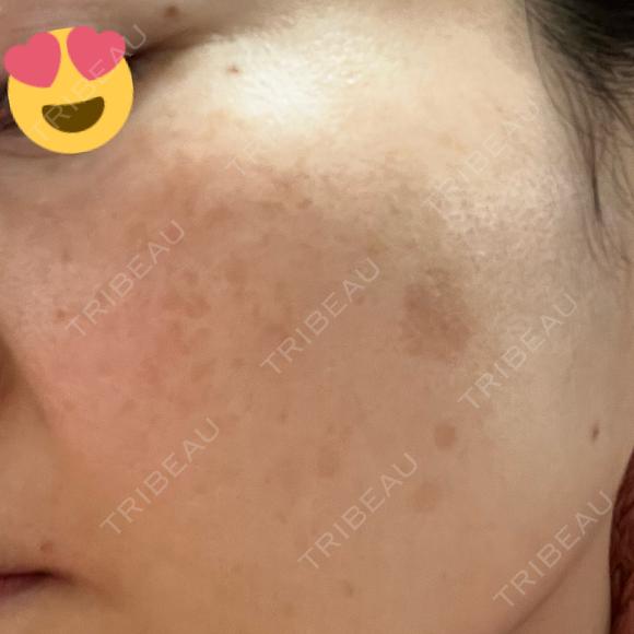 シミ取りレーザー Jスキンクリニック 【J-SKIN clinic】 DAY 15 メイン用