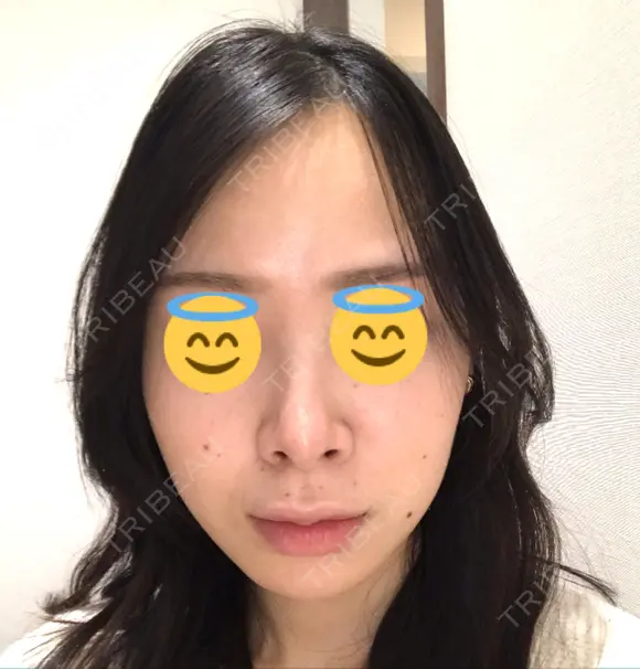 鼻尖形成（切開） / 軟骨移植 JUN CLINIC DAY 33 メイン用