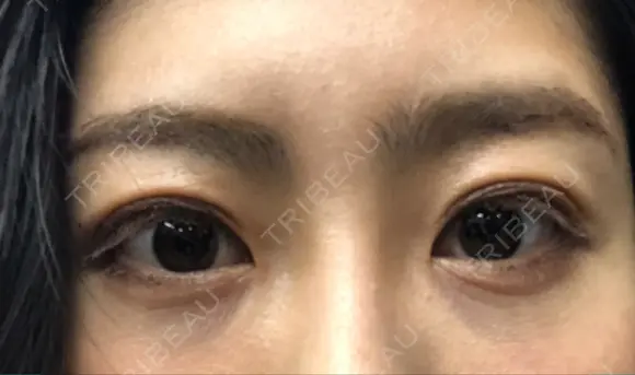 二重埋没 湘南美容クリニック 品川院 DAY 20 メイン用