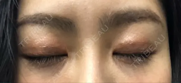 二重埋没 湘南美容クリニック 品川院 DAY 20 メイン用