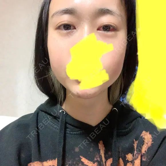 下まぶたたるみ取り / ヒアルロン酸注入（あご） / ボトックス（エラ・小顔） コスメディカルクリニック シンシア 銀座院 DAY 1 メイン用