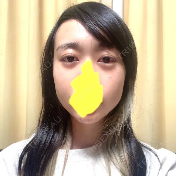 下まぶたたるみ取り / ヒアルロン酸注入（あご） / ボトックス（エラ・小顔） コスメディカルクリニック シンシア 銀座院 DAY 2 メイン用