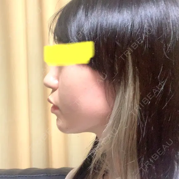 下まぶたたるみ取り / ヒアルロン酸注入（あご） / ボトックス（エラ・小顔） コスメディカルクリニック シンシア 銀座院 DAY 2 メイン用