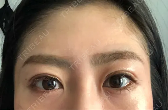 二重埋没 湘南美容クリニック 品川院 DAY 20 メイン用