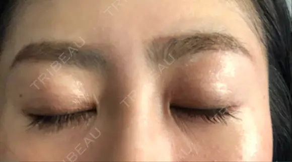 二重埋没 湘南美容クリニック 品川院 DAY 20 メイン用