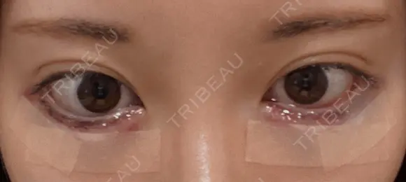 タレ目形成・グラマラスライン（切開） / タレ目形成・グラマラスライン（埋没） リッツ美容外科 東京院 DAY 0 メイン用