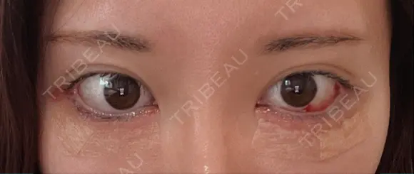 タレ目形成・グラマラスライン（切開） / タレ目形成・グラマラスライン（埋没） リッツ美容外科 東京院 DAY 1 メイン用