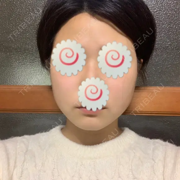 脂肪溶解注射（顔） 聖心美容クリニック 福岡院 AFTER メイン用