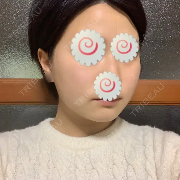 脂肪溶解注射（顔） 聖心美容クリニック 福岡院 DAY 6 メイン用