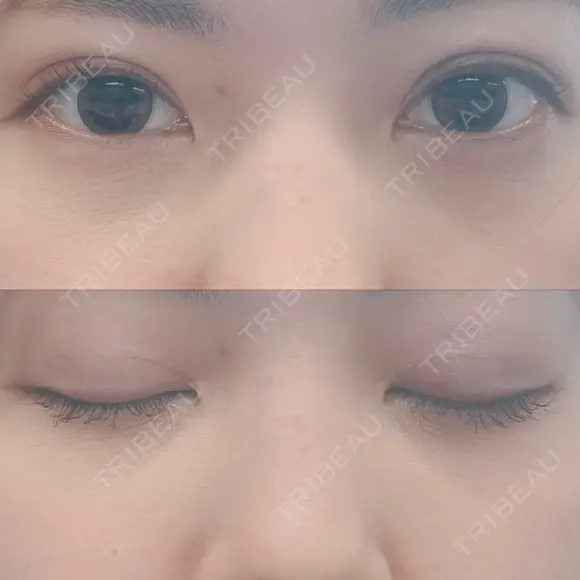二重埋没 AILE Clinic DAY 22 メイン用