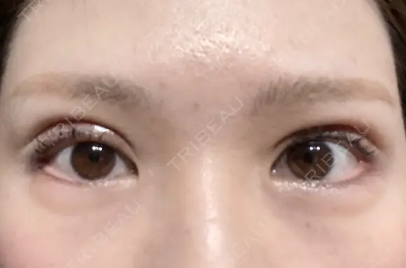 眼瞼下垂（切開） ステラ ロサ クリニック DAY 13 メイン用