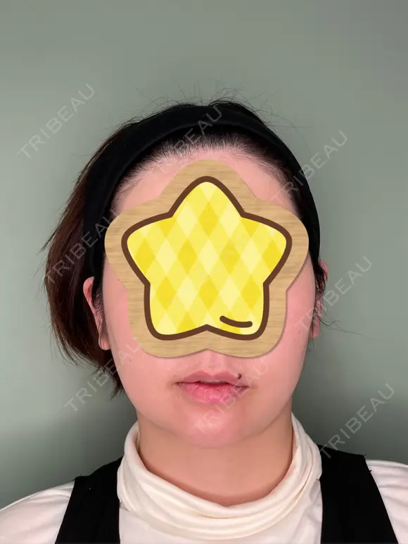 あごプロテーゼ くさのたろうクリニック DAY 27 メイン用
