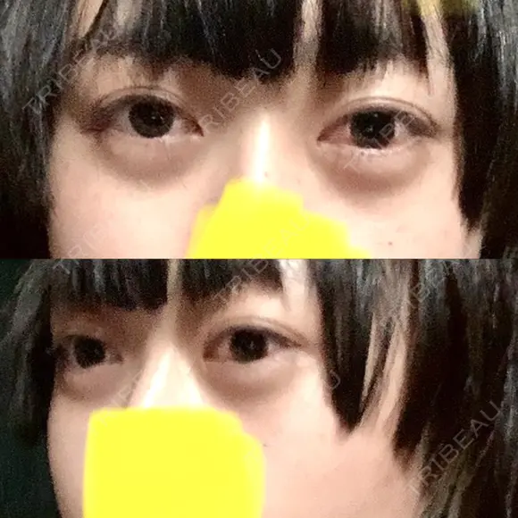 下まぶたたるみ取り / ヒアルロン酸注入（あご） / ボトックス（エラ・小顔） コスメディカルクリニック シンシア 銀座院 DAY 7 メイン用