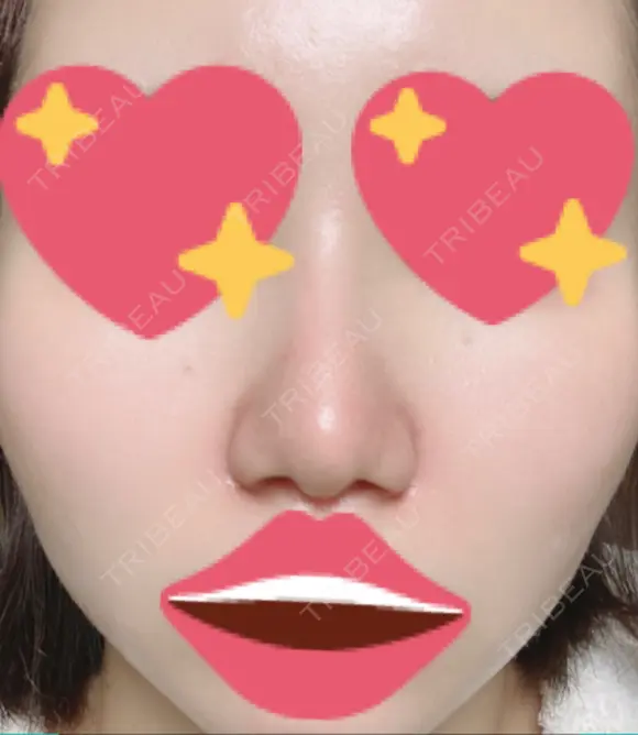 隆鼻術 / 軟骨移植 フェアクリニック川口 DAY 14 メイン用