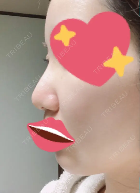 隆鼻術 / 軟骨移植 フェアクリニック川口 DAY 14 メイン用