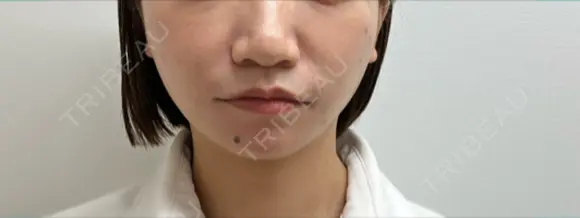 糸リフト 渋谷美容外科クリニック 渋谷院 DAY 2 メイン用