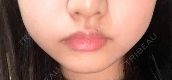 ボトックス（エラ・小顔） 湘南美容クリニック 名古屋栄院 DAY 0 メイン用