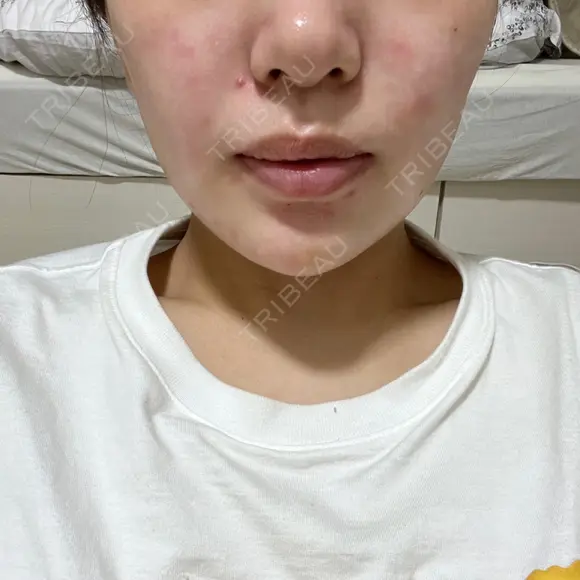 糸リフト / バッカルファット除去 / 脂肪吸引（顔） 湘南美容クリニック 京都院 DAY 37 メイン用