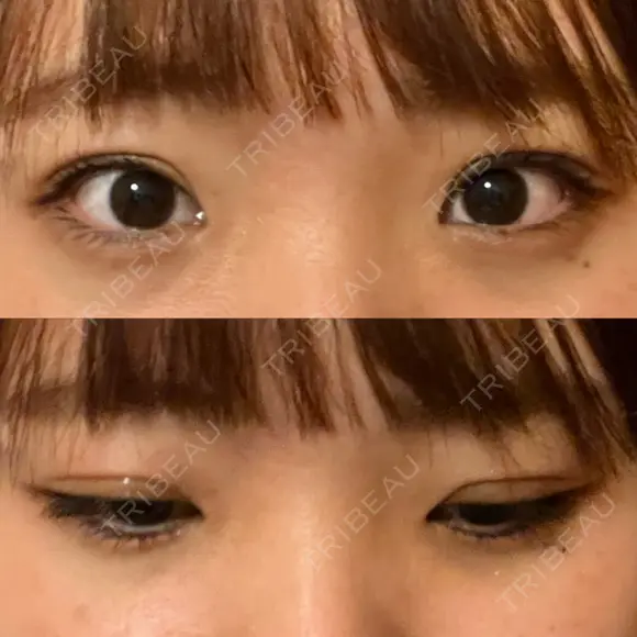 二重埋没 湘南美容クリニック 大阪心斎橋院 DAY 19 メイン用