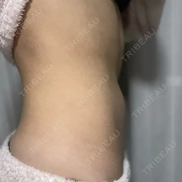 脂肪冷却（お腹） AI Beauty Clinic （エーアイ美容クリニック） DAY 42 メイン用