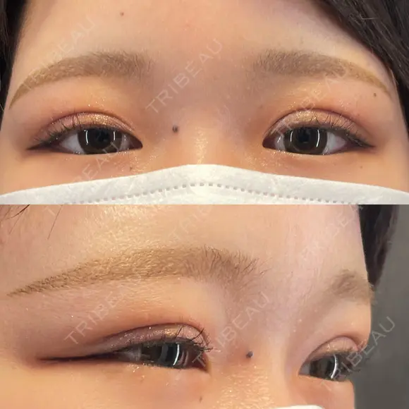 二重埋没 / 上まぶたの脂肪取り X CLINIC 福岡天神院 AFTER メイン用