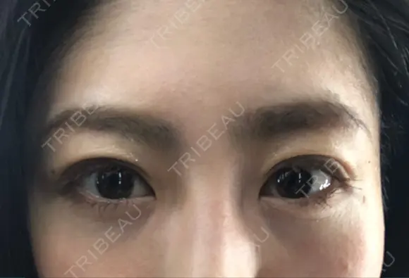 二重埋没 湘南美容クリニック 品川院 DAY 20 メイン用