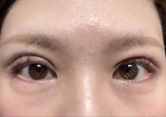 眼瞼下垂（切開） ステラ ロサ クリニック DAY 18 メイン用