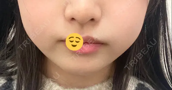 ボトックス（エラ・小顔） 湘南美容クリニック 名古屋栄院 DAY 3 メイン用