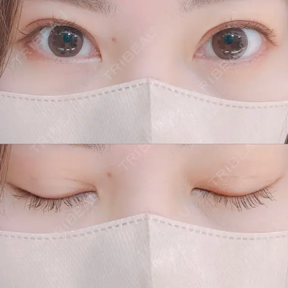 二重埋没 AILE Clinic DAY 27 メイン用