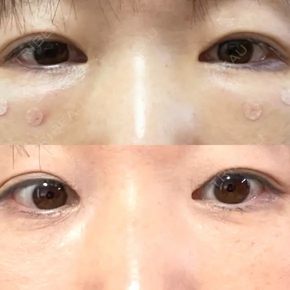 クマ治療 / 脂肪注入（肌） / ボトックス（あご） 銀座みゆき通り美容外科 大阪梅田院 DAY 62 メイン用