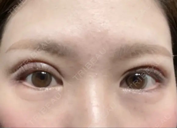 眼瞼下垂（切開） ステラ ロサ クリニック AFTER メイン用
