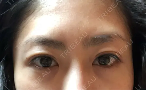 二重埋没 湘南美容クリニック 品川院 AFTER メイン用