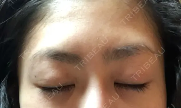 二重埋没 湘南美容クリニック 品川院 DAY 21 メイン用