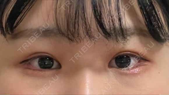 ヒアルロン酸注入（涙袋） プリモ麻布十番クリニック DAY 2 メイン用
