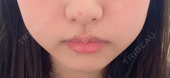 ボトックス（エラ・小顔） 湘南美容クリニック 名古屋栄院 DAY 7 メイン用